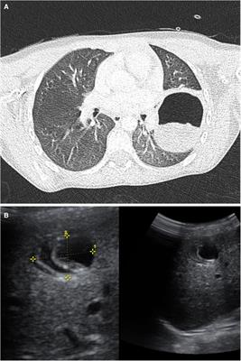 The impact of detailed history taking: a case report of pediatric pulmonary and hepatic hydatid disease from Ecuador